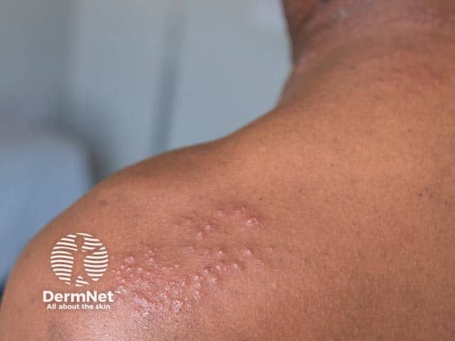 Herpes Zoster Image