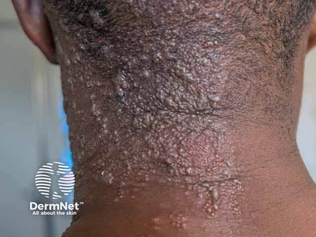 Shingles affecting the neck in HIV infection