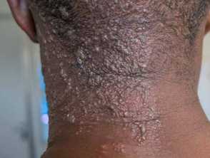 skin lesions aids