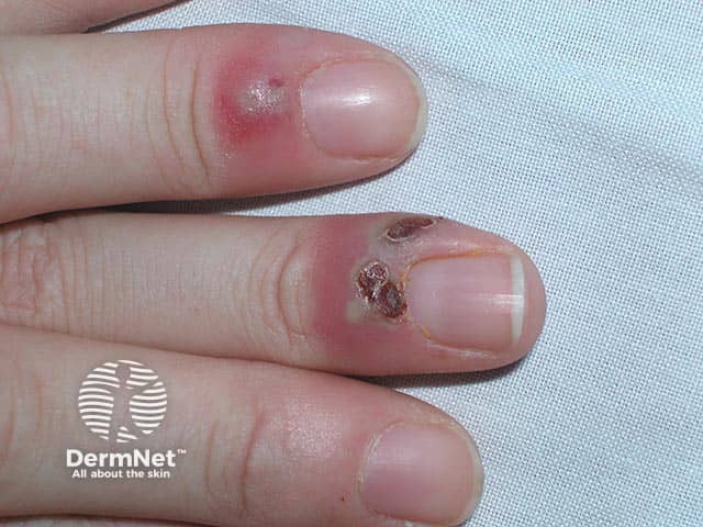 Several nail folds are affected by herpetic whitlow in a woman receiving chemotherapy