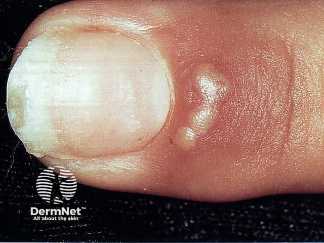Clustered clear vesicles on the proximal nail fold typical of an early phase of a herpetic whitlow