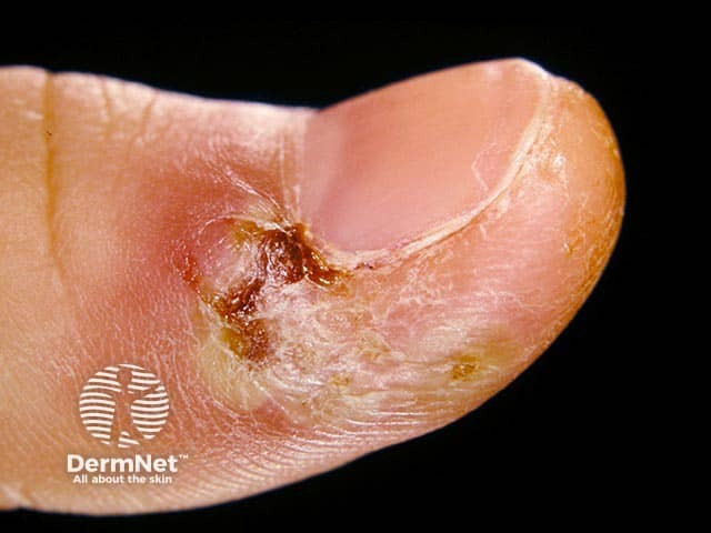 A herpetic whitlow on the thumb five days after onset