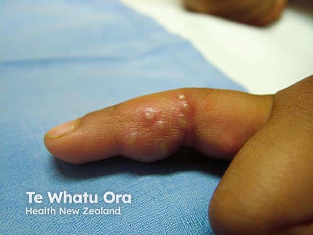 Clustered clear vesicles and oedema in an early herpetic whitlow in skin of colour