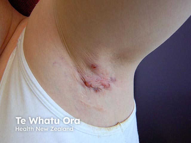 Hidradenitis suppurativa in the axilla - nodules, sinuses, and scars are evident