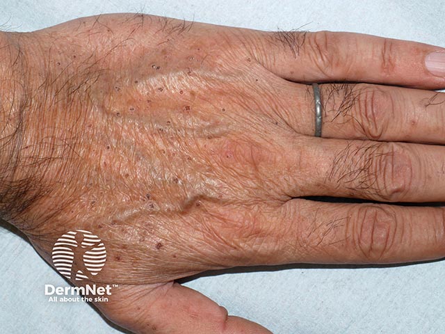 Red 3-4 mm scaly papules, typical of Flegel's disease, on the hand