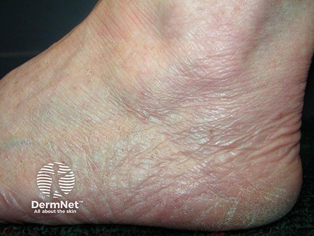 3-4 mm scaly papules over the feet in Flegel's disease