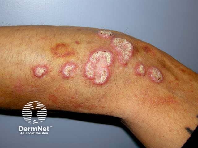 Verrucous and unusually hyperkeratotic hypertrophic lichen planus on the arm