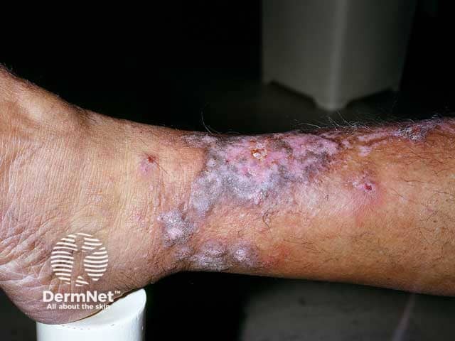 Large plaques of purple hypertrophic lichen planus on the shin and ankle