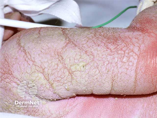 Ichthyosis prematurity syndrome skin at 48 hrs of life