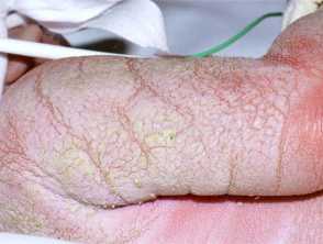 Ichthyosis prematurity syndrome