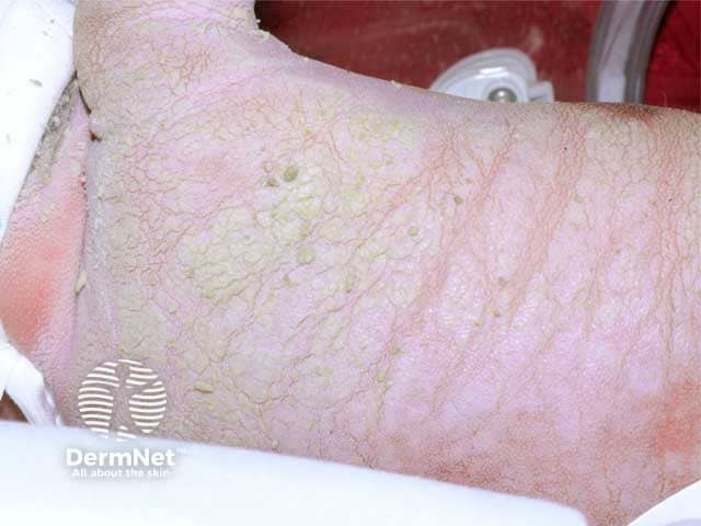 Ichthyosis prematurity syndrome - thick hyperkeratotic skin over the back at 48 hrs of life