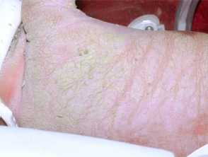 Ichthyosis prematurity syndrome