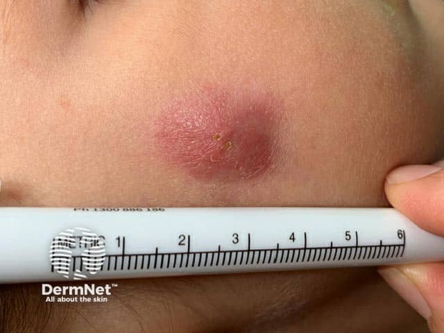 Indurated plaque over the cheek in a child with idiopathic facial aseptic granuloma