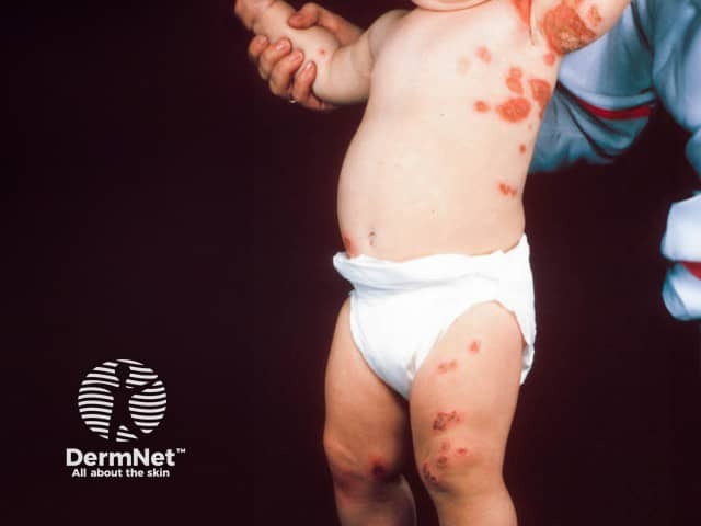 'Kissing lesions' on both sides of the axilla in impetigo