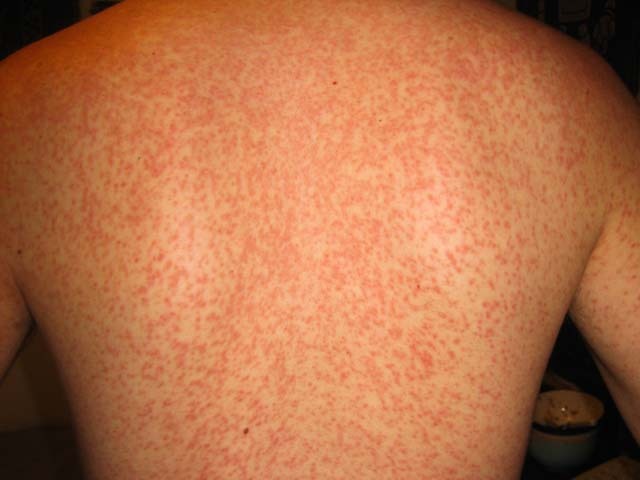 Infectious mononucleosis: ampicillin rash. Wikimedia Commons