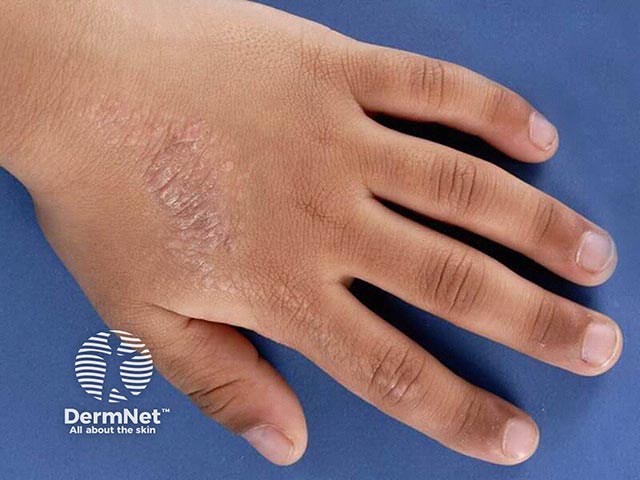 An inflamed epidermal naevus extending onto the hand