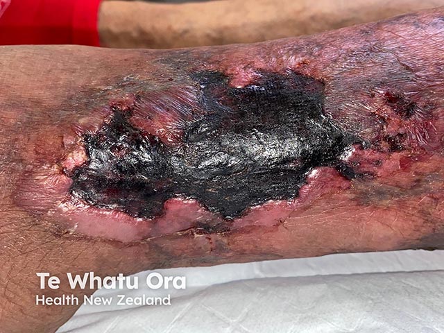 Post-traumatic ischaemic ulceration on the shin