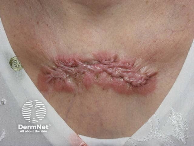 A large post-surgical presternal keloid