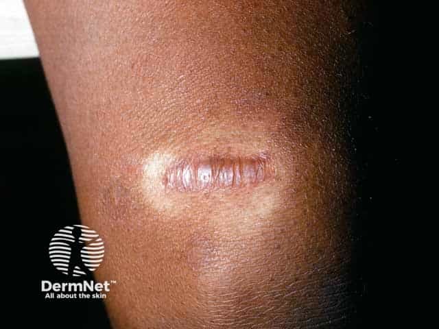 Hypopigmentation after intralesional steroid injection to a keloid scar