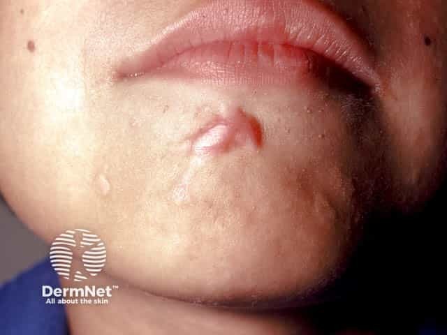 A keloid scar after cryotherapy to a chin viral wart