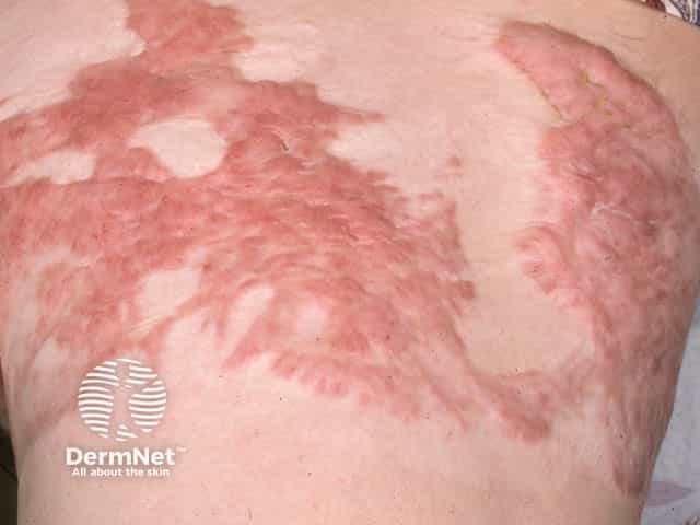 Keloid scarring after skin grafting