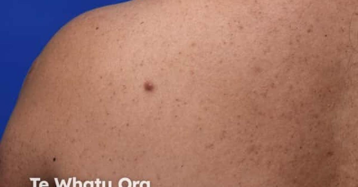 Keloid scar image