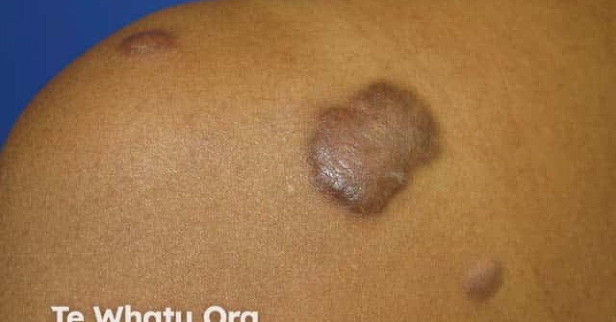 Keloid scar image