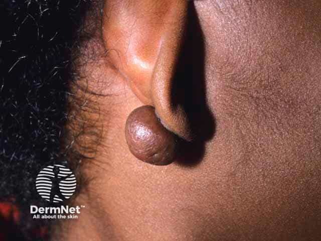 An earlobe keloid post piercing