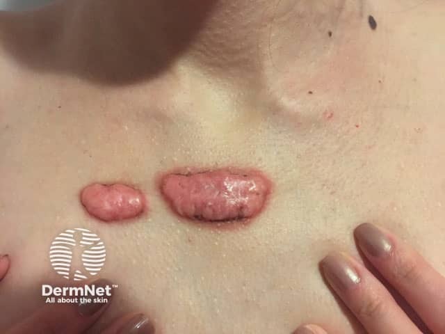 Post-acne keloids on the chest, pre-excision, and post-operative irradiation