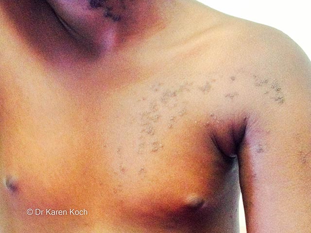 An epidermal naevus in skin of colour - it follows Blaschko lines
