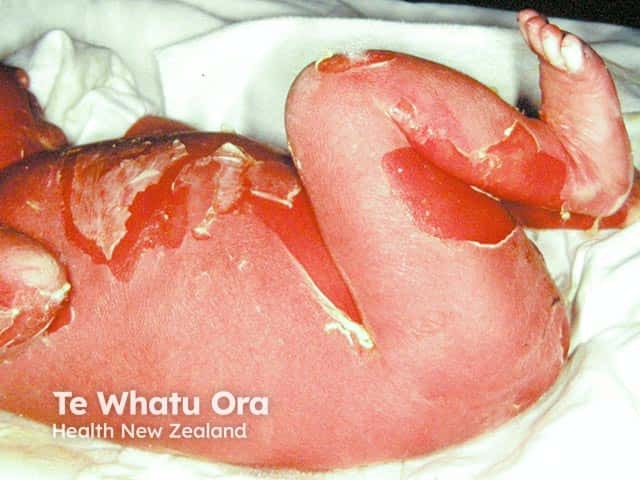 Denuded areas of skin on the legs and abdomen with erythroderma in a neonate with bullous ichthyosiform erythroderma