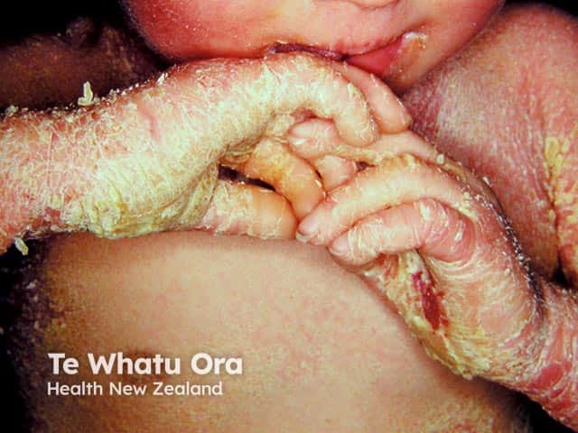 Severe palmar keratoderma and extensive scaling over the chest in a baby with bullous ichthyosifrom erythroderma