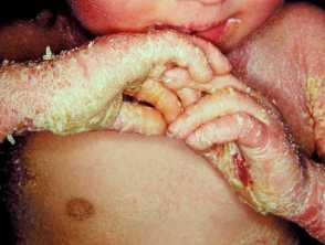 ichthyosis bullosa of siemens