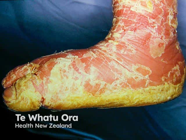 Severe plantar keratoderma and redness of the foot and ankle in bullous ichthyosiform erythroderma