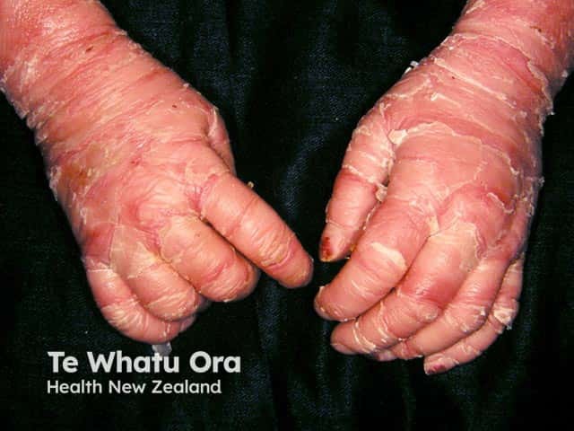 Peeling and redness on the hands due to bullous ichthyosifrom erythroderma