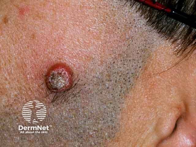 Keratoacanthoma on the cheek