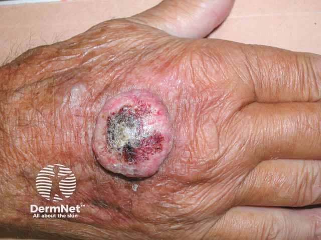 Giant keratoacanthoma on the hand