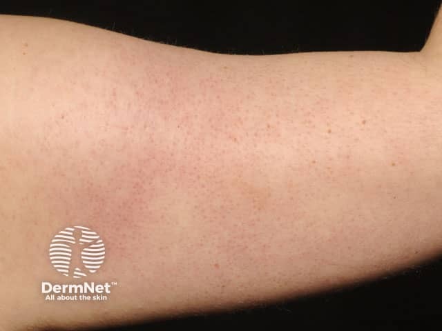 Keratotic papules on the back of the upper arm in keratosis pilaris