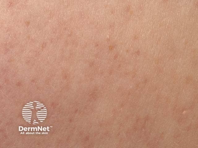 Close up of keratosis pilaris on the arm