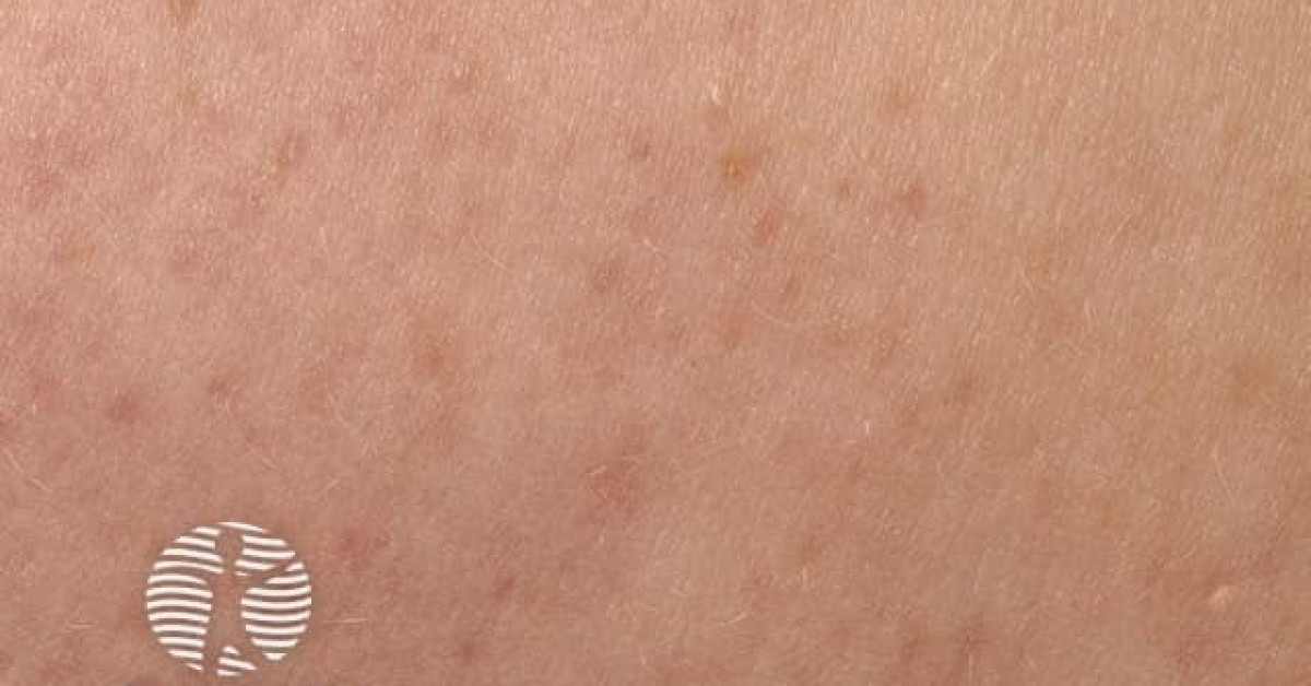 Keratosis pilaris image