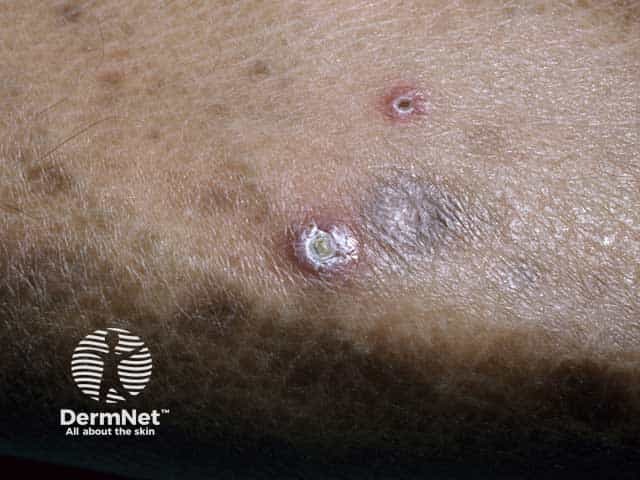 A papule with a central plug of transepidermally eliminated collagen in Kyrle disease