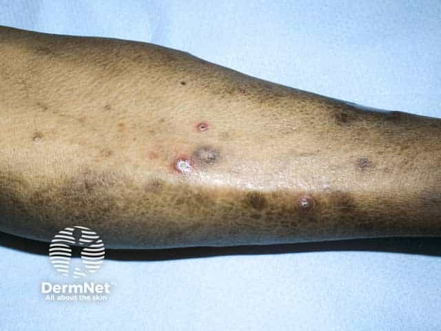 Papules with central warty plugs on the leg in Kyrle disease