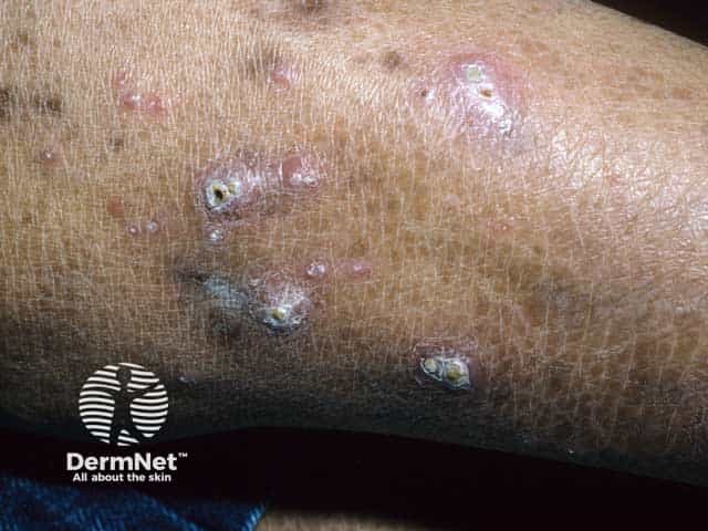Kyrle disease on the skin