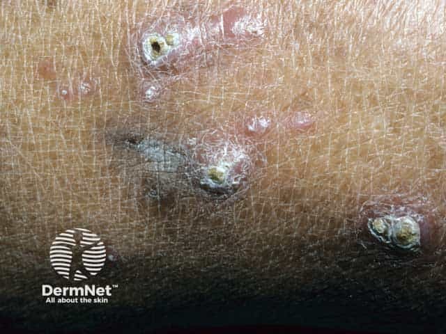 Warty papules of Kyrle disease due to collagen eliminatoin through the epidermis