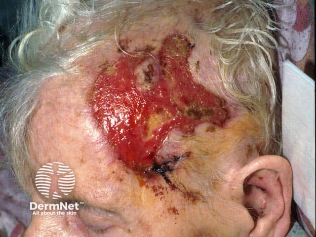 The extending ulcer on this lady's temple was the result of temporal arteritis, which had caused visual loss and ultimately coma
