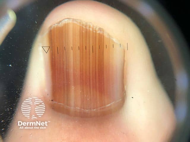 Longitudinal melanonychia in Laugier-Hunziker syndrome