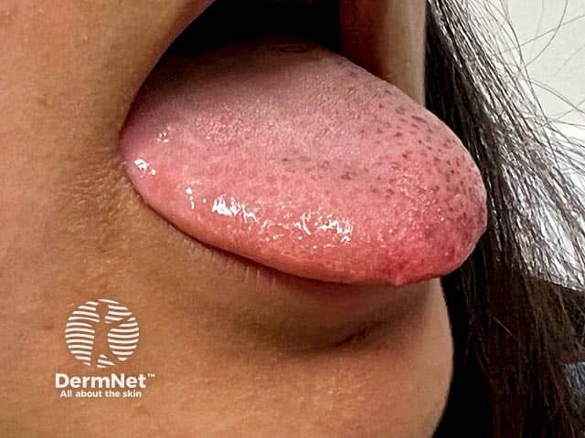 Pigmented macules on the tongue in Laugier-Hunziker syndrome - there may be similar pigmentation on the lips and palate