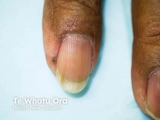 Periungual pigmentation in Laugier-Hunziker syndrome