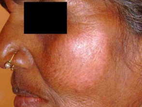 leprosy tuberculoid 00001