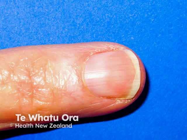 'Half and half nail': leukonychia is affecting the proximal half of the nail